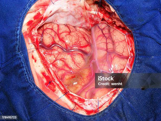 Arteriovenous Malformation In Das Gehirn Stockfoto und mehr Bilder von Blauer Hintergrund - Blauer Hintergrund, Deformiert, Endhirn