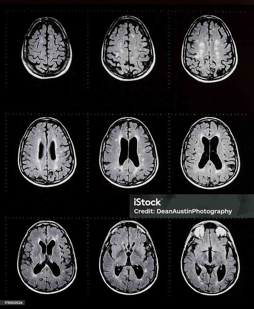 RMI del cervello con sclerosi multipla - Foto stock royalty-free di Sclerosi multipla
