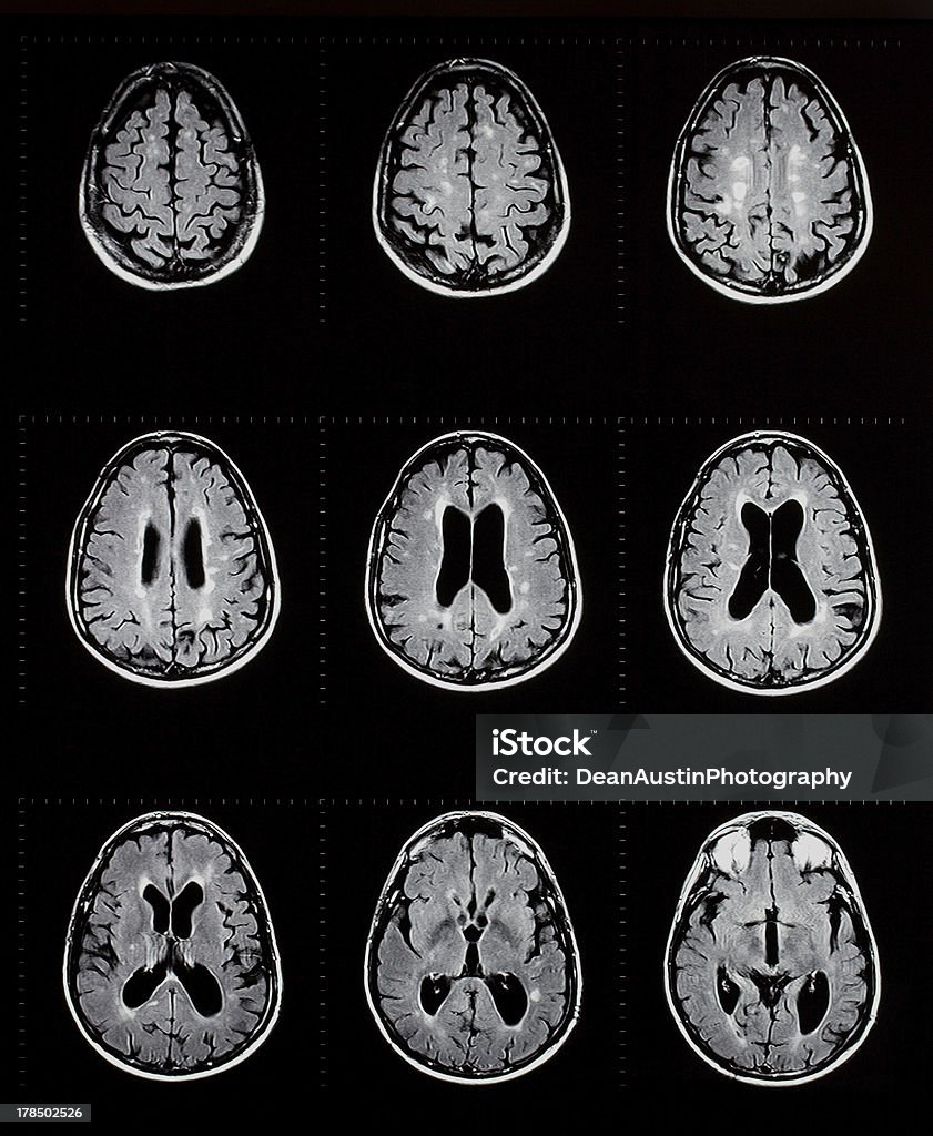 mri の脳を示す多発性硬化症 - 多発性硬化症のロイヤリティフリーストックフォト