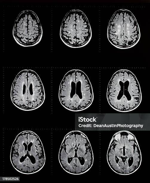 Mri の脳を示す多発性硬化症 - 多発性硬化症のストックフォトや画像を多数ご用意 - 多発性硬化症, MRI装置, MRI検査