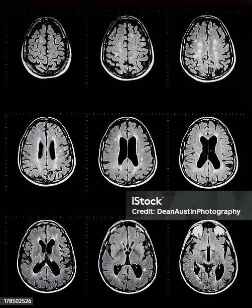 Foto de Mri De Cérebro Mostrando Esclerose Múltipla e mais fotos de stock de Esclerose Múltipla - Esclerose Múltipla, Encefalograma, Exame de ressonância magnética