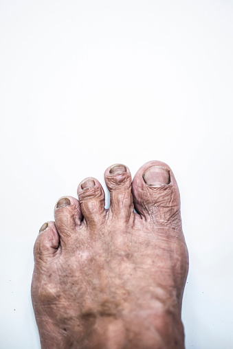 The image of the feet of an old man with rough dryness