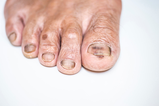 The toenail of the elderly on a white background
