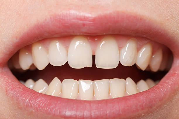 Diastema  between the upper incisors Diastema between the upper incisors is a normal feature gap toothed photos stock pictures, royalty-free photos & images