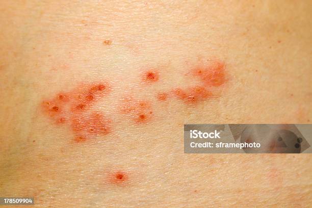 Shingles Rash Stock Photo - Download Image Now - Shingles, Skin Condition, Chickenpox