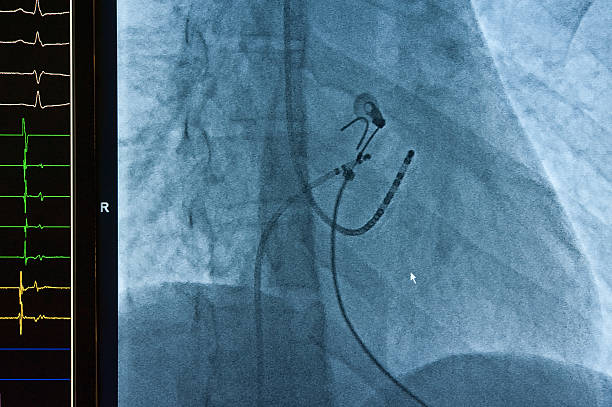 katheter ablation für atrial fibrillation - human heart surveillance computer monitor pulse trace stock-fotos und bilder