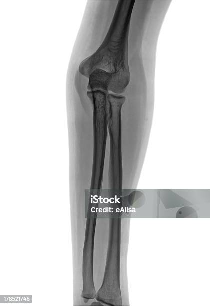 Foto de Cotovelo Raiox Negativo e mais fotos de stock de Anatomia - Anatomia, Articulação humana, Branco