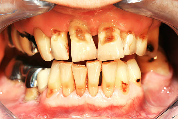 Teeth abrasion Teeth abrasion result of incorrect teeth cleaning decay stock pictures, royalty-free photos & images