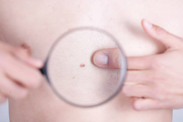 istock Close-up of a mole on persons chest under a magnifying glass 178569891