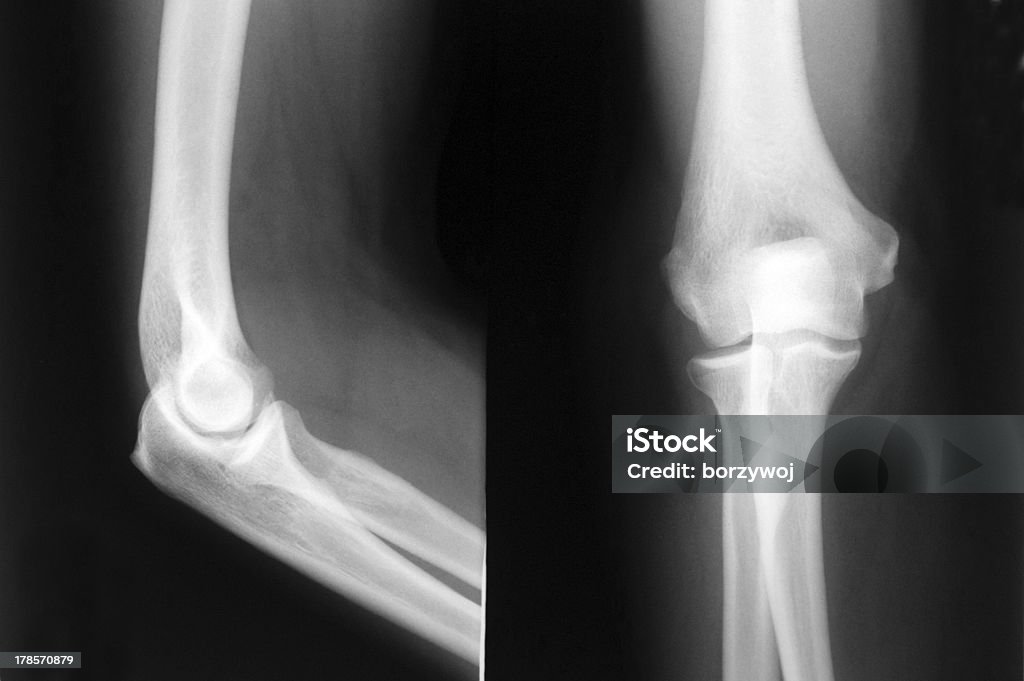 Codo de rayos x - Foto de stock de Anatomía libre de derechos