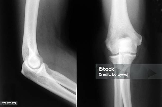 Codo De Rayos X Foto de stock y más banco de imágenes de Anatomía - Anatomía, Articulación humana, Asistencia sanitaria y medicina