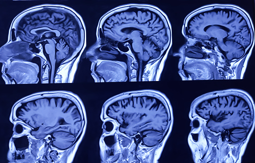 MRI (Magnetic Resonance Image) of brain. Cerebral cortical atrophy.