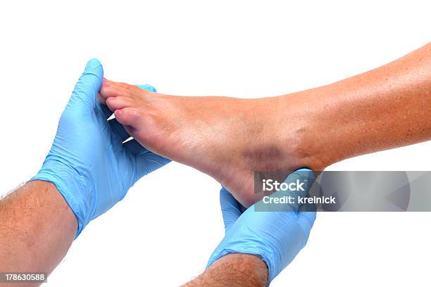 Ankle Bruise Stock Photo - Download Image Now - Doctor, Bruise, Ankle