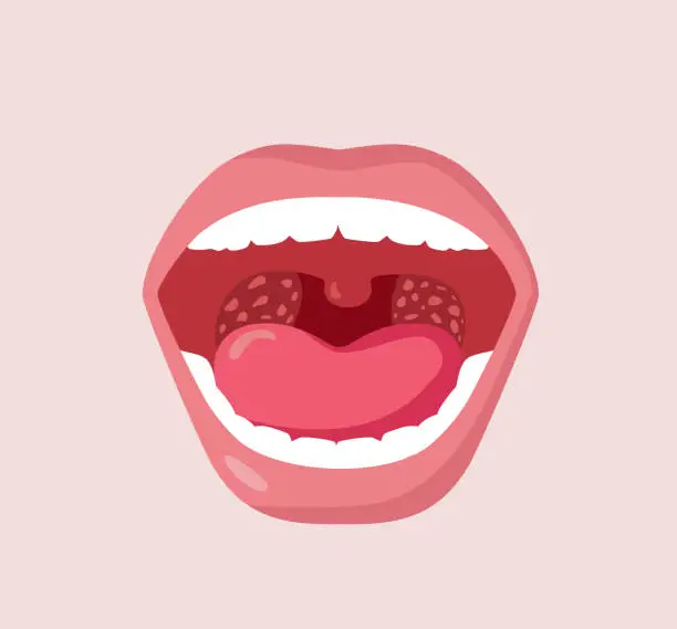 Vector illustration of Tonsils inflammation Vector Concept Image of an Open Mouth