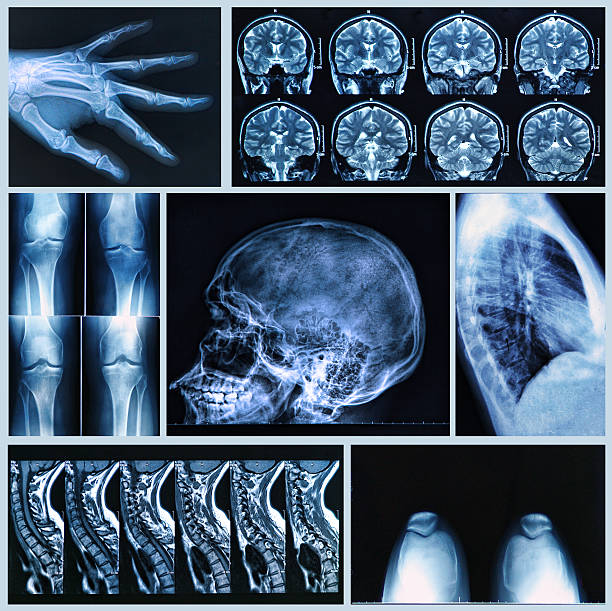 istock Radiography of Human Bones 178712807