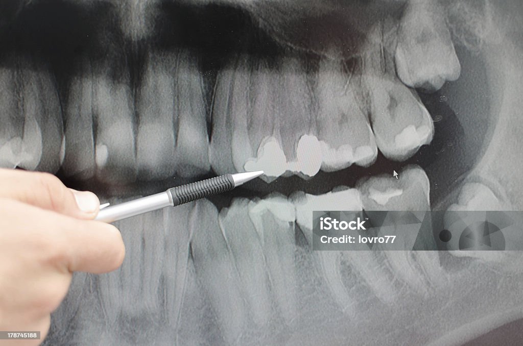 X-Ray dentaire - Photo de Analyser libre de droits