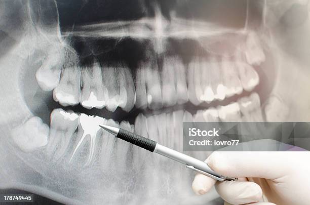 Radiografía Dental Foto de stock y más banco de imágenes de Agarrar - Agarrar, Analizar, Asistencia sanitaria y medicina