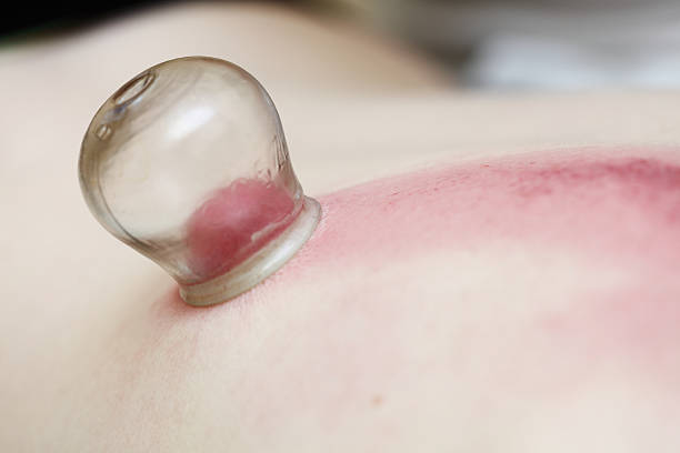 istock fire cupping treatment to cup sb therapy woman 178757797