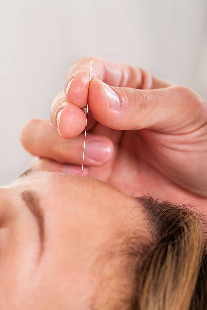 trattamento di agopuntura in fase di donna - acupuncture spa treatment asian culture medicine foto e immagini stock