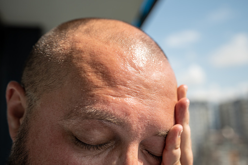 Man forehead, sunstroke, sweat on face, bald head. Close up. Guy suffers from heat, high temperature and humidity, pressure, being in hot scorching summer sun at balcony, overheating superheating