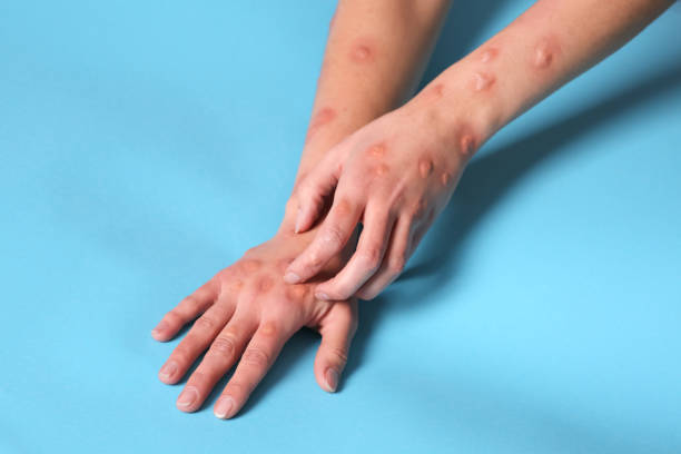 istock Woman with rash suffering from monkeypox virus on light blue background, closeup 1788198844