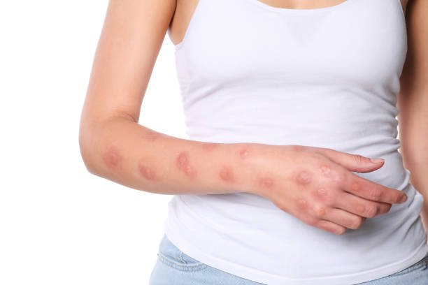 istock Woman with rash suffering from monkeypox virus on white background, closeup 1788198963