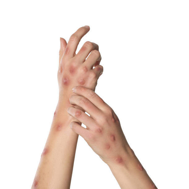 istock Woman with rash suffering from monkeypox virus on white background, closeup 1788200945