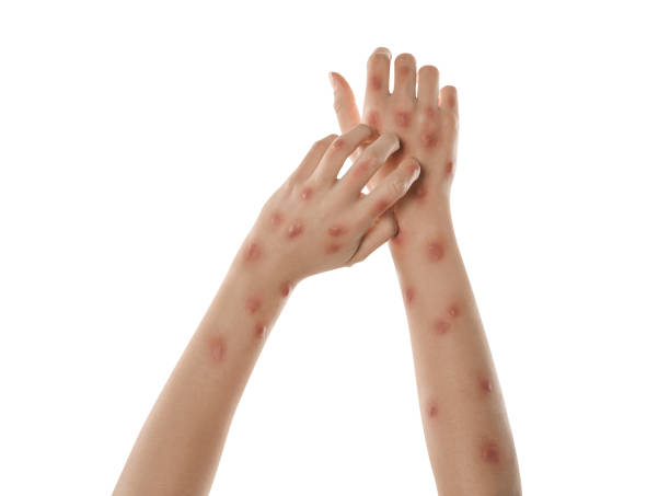 istock Woman with rash suffering from monkeypox virus on white background, closeup 1788200947
