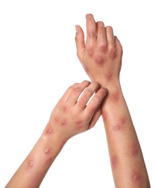istock Woman with rash suffering from monkeypox virus on white background, closeup 1788200968