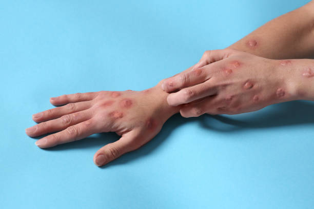 istock Woman with rash suffering from monkeypox virus on light blue background, closeup 1788201481