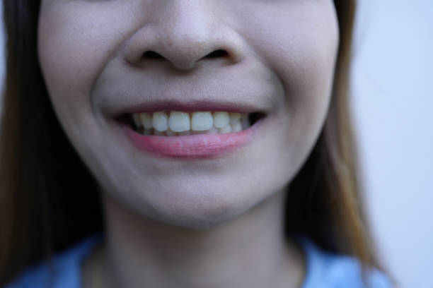 Asian woman smiling showing teeth