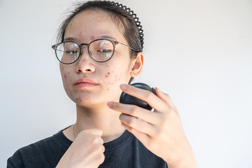 Conceptual shot of Acne and Problem Skin on female face.