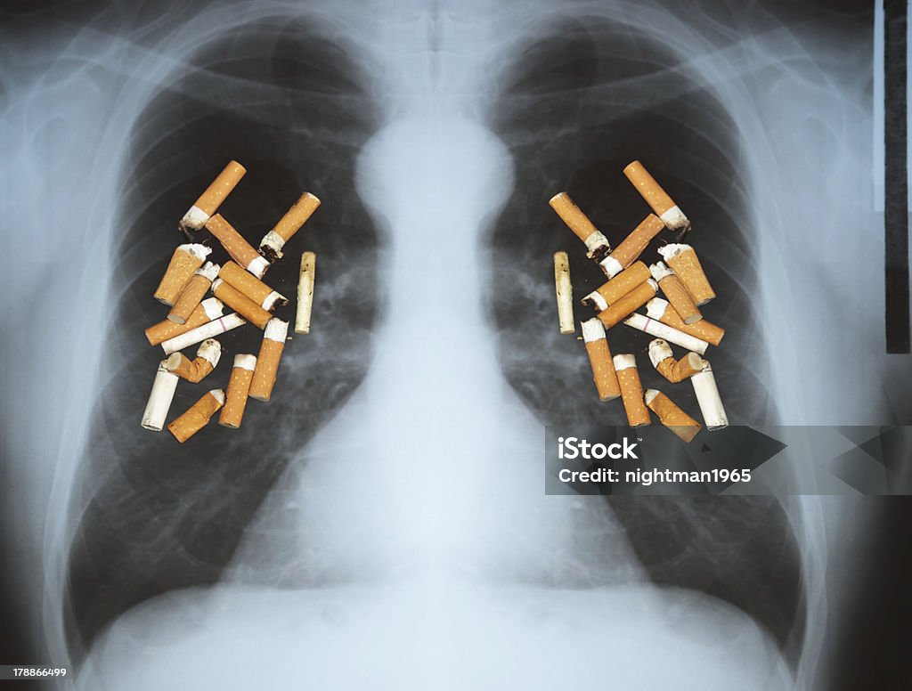 Lung cancer Effects of cigarette smoking - lung cancer. Addiction Stock Photo