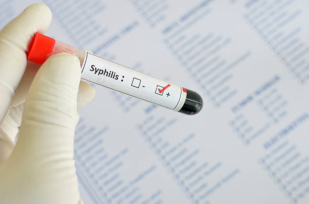 syphilis positive - serology photos et images de collection