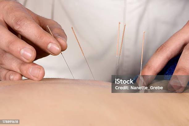 Physiotherapist Doing Accupuncture Stock Photo - Download Image Now - Acupuncture, Adult, Alternative Therapy