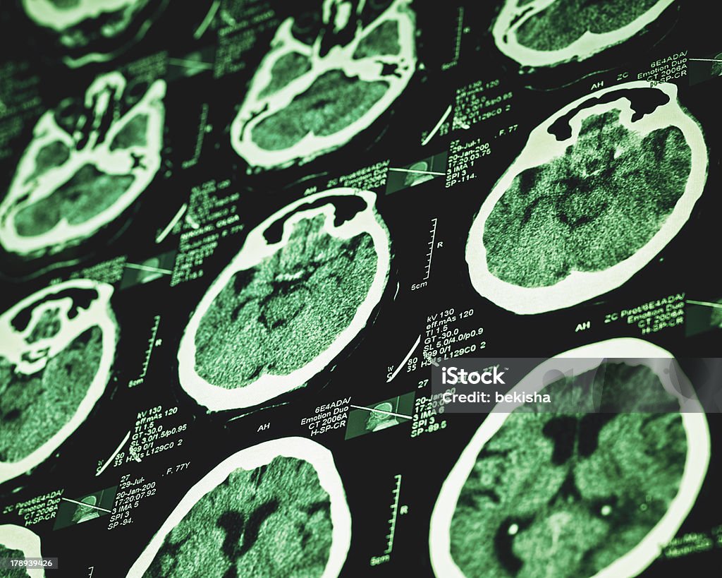 TAC result close-up - Foto stock royalty-free di Cervello umano