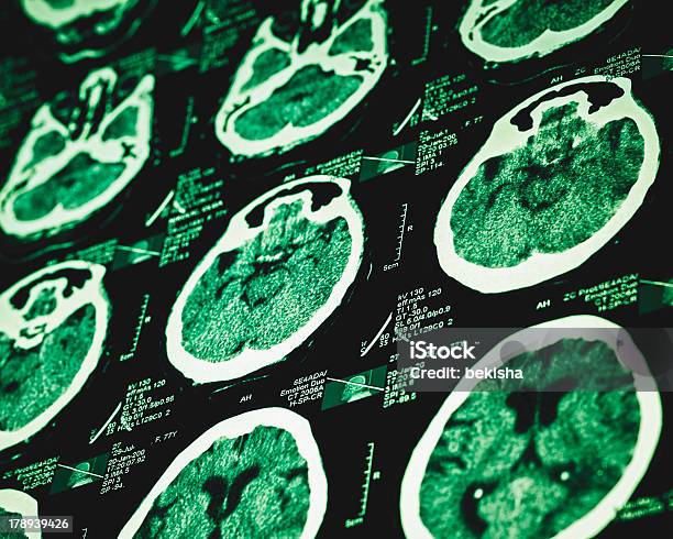 Ct 스캔 결과 클로즈업 MRI 스캔에 대한 스톡 사진 및 기타 이미지 - MRI 스캔, X-레이, 건강 검진 결과