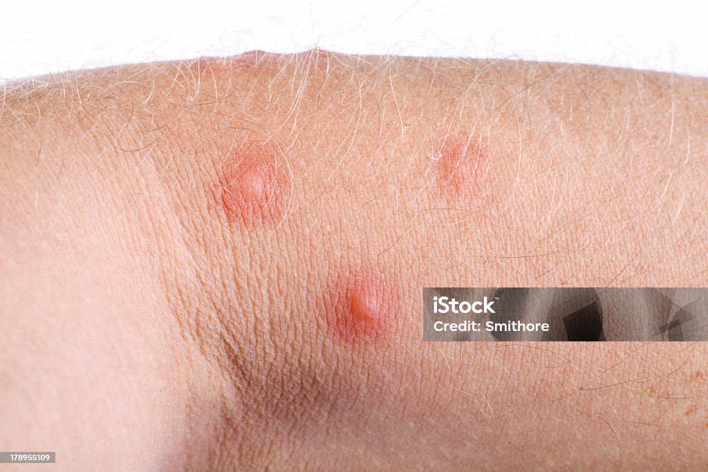 3 raised pimples on the akin of a human forearm macro of allergy pimples on male skin armMy similar images: 2000-2009 Stock Photo