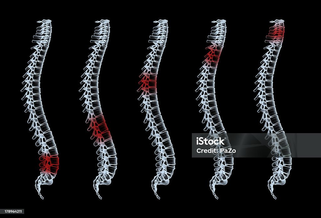バックボーン痛み - 3Dのロイヤリティフリーストックフォト