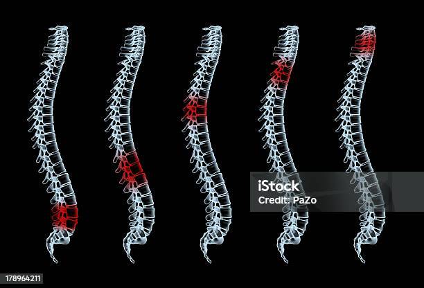 バックボーン痛み - 3Dのストックフォトや画像を多数ご用意 - 3D, イラストレーション, ヘルスケアと医療