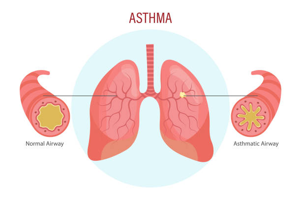 Asthma, lung disease. Medical infographic banner, illustration Asthma, lung disease. Medical infographic banner, illustration, vector erythema nodosum stock illustrations