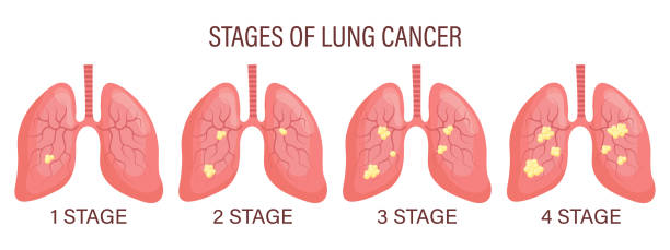 Stages of lung cancer, lung disease. Medical infographic banner, illustration Stages of lung cancer, lung disease. Medical infographic banner, illustration, vector erythema nodosum stock illustrations