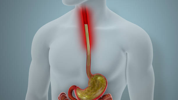 Acid Reflux GERD Disease Illustration