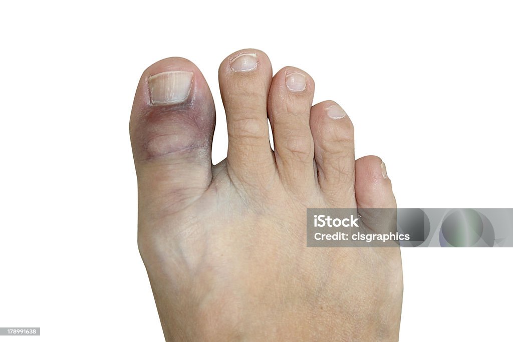 Bruised and broken big toe isolated on white A discolored purple toe that is either broken or sprained isolated on white Bruise Stock Photo