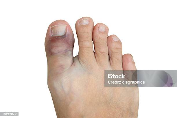 Bruised And Broken Big Toe Isolated On White Stock Photo - Download Image Now - Bruise, Bone Fracture, Broken