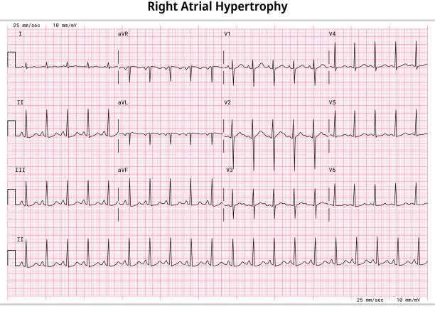 illustrazioni stock, clip art, cartoni animati e icone di tendenza di ecg ipertrofia atriale destra (rah) - ingrandimento atriale destro (rae) - 12 derivazioni ecg caso comune - 3 sec/derivazione - human heart pulse trace heart valve cardiac conduction system