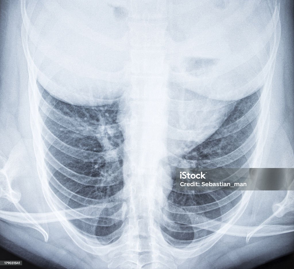 胸 X 線画像 - X線撮影のロイヤリティフリーストックフォト