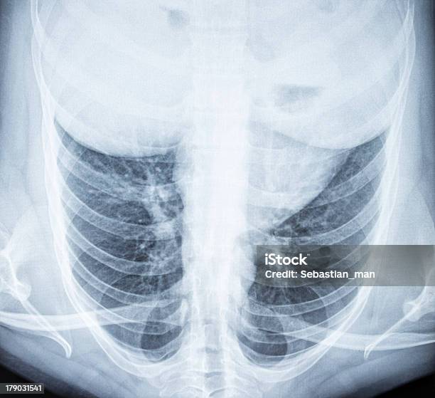 胸 X 線画像 - X線撮影のストックフォトや画像を多数ご用意 - X線撮影, データ, ネガ