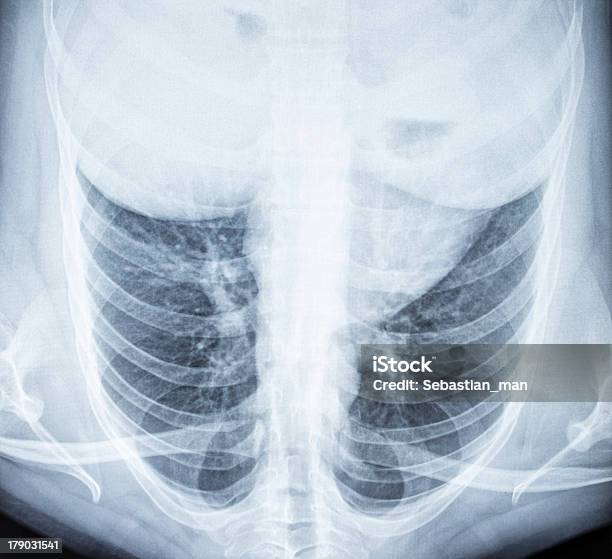 흉부 X선 이미지 0명에 대한 스톡 사진 및 기타 이미지 - 0명, X-레이, 건강 진단