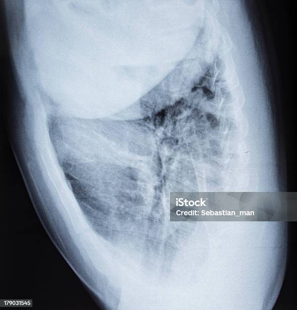 Рентгенография Грудной Клетки Изображение — стоковые фотографии и другие картинки Анатомия - Анатомия, Без людей, Болезнь